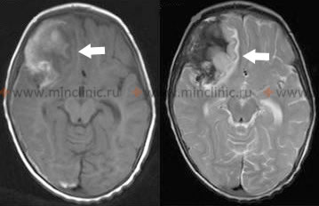 На МРТ головного мозга показан разрыв аневризмы в правой лобной доле головного мозга.